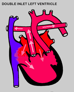Double Inlet Left Ventricle