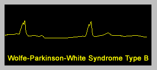Wolfe-Parkinson-White Syndrome